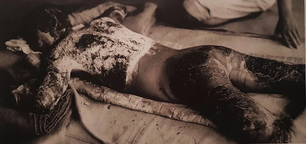 Hiroshima museum photograph of burns